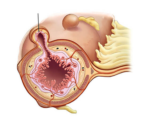 Medical illustration of diverticula in the bowel wall