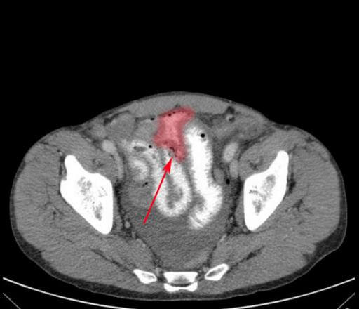 Medical 3D illustration of perforated colon